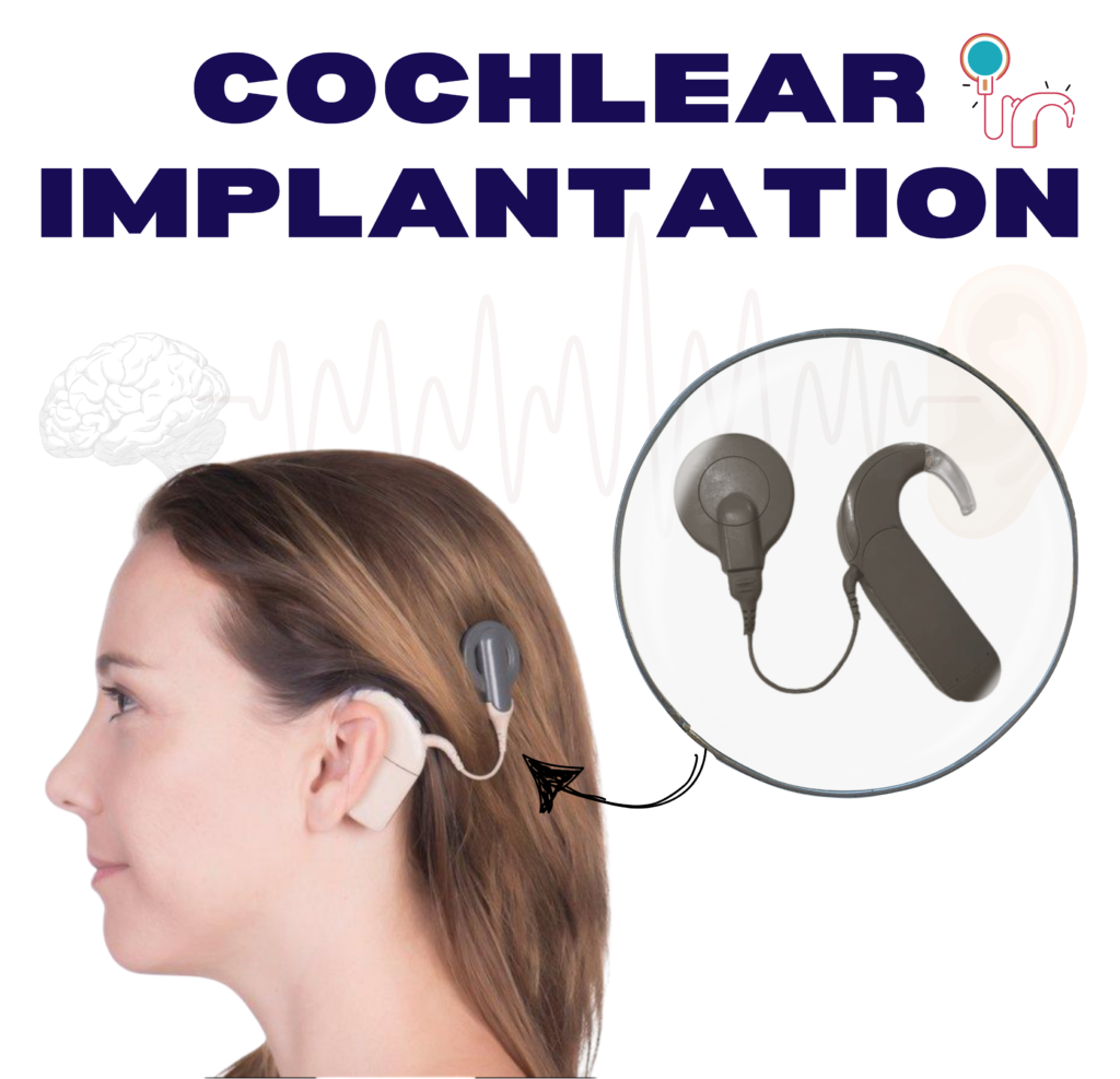 Cochlear Implantation