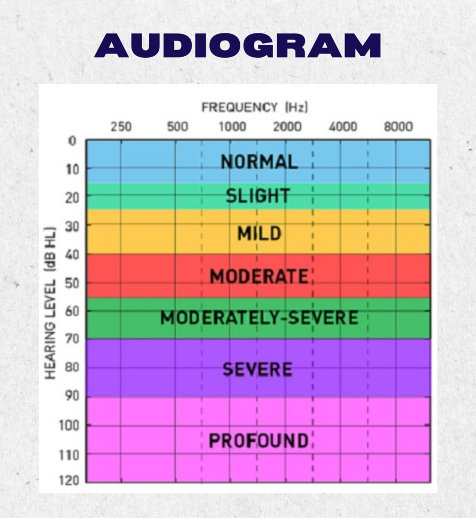 Audiogram to represent results of audiometry