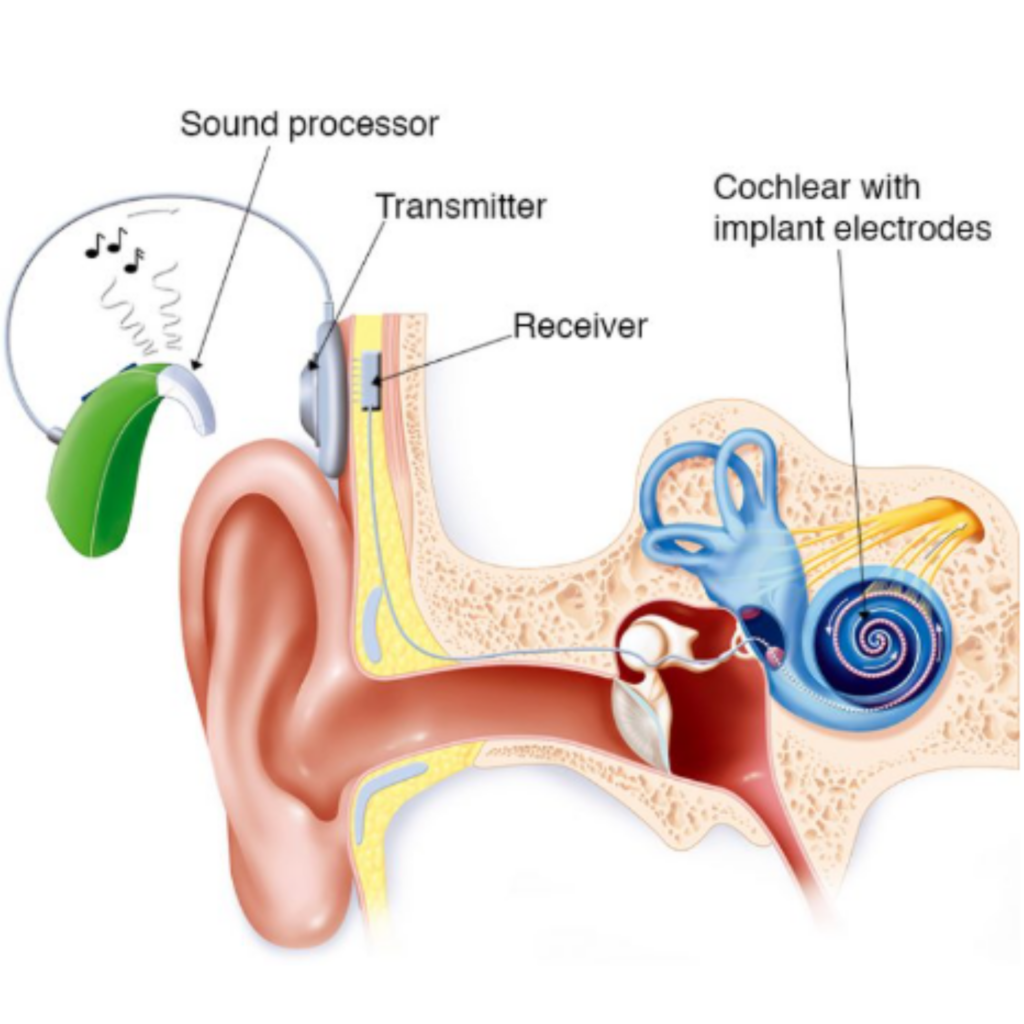 Working of cochlear implant